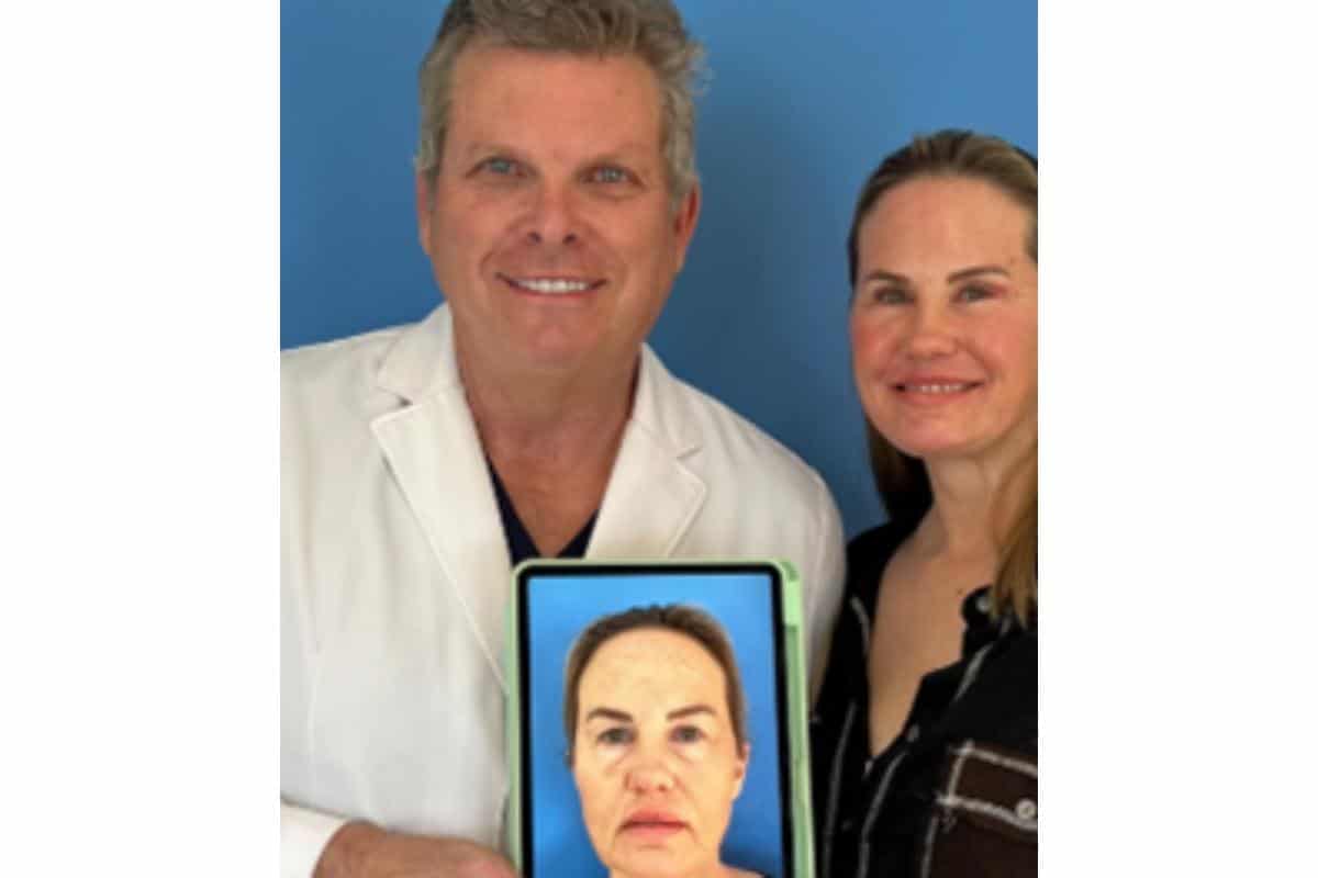 Brow Lift San Diego