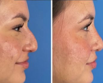 Revision Rhinoplasty San Diego