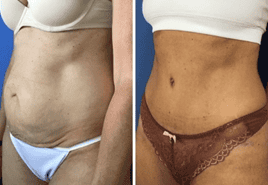 Mini Tummy Tuck San Diego