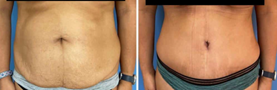 Extended Tummy Tuck San Diego