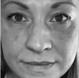 Woman with smooth skin after laser treatment in San Diego, Ca