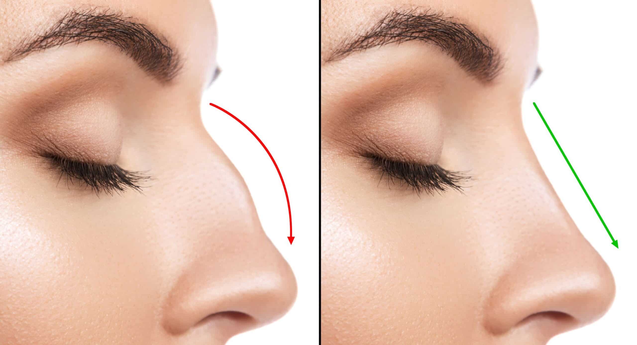 Rhinoplasty in Jupiter & Miami