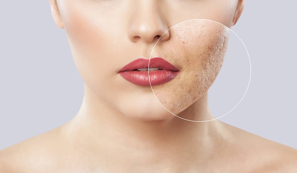 How Laser Skin Resurfacing Can Transform Your Complexion